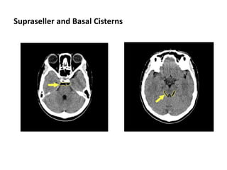 Supraseller and Basal Cisterns
 