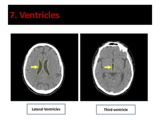 7. Ventricles
Lateral Ventricles Third ventricle
 