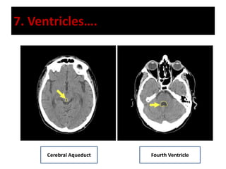 7. Ventricles….
Cerebral Aqueduct Fourth Ventricle
 