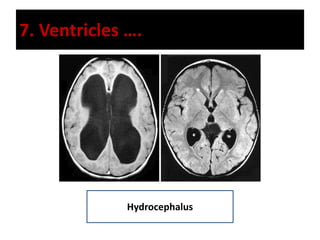 7. Ventricles ….
Hydrocephalus
 