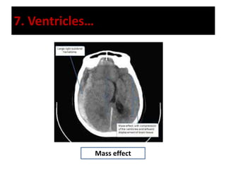 7. Ventricles…
Mass effect
 