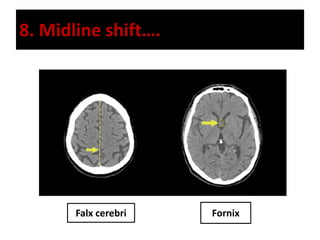 8. Midline shift….
Falx cerebri Fornix
 