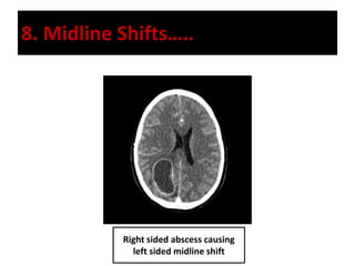 8. Midline Shifts…..
Right sided abscess causing
left sided midline shift
 