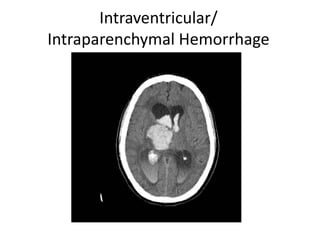 Intraventricular/
Intraparenchymal Hemorrhage
 