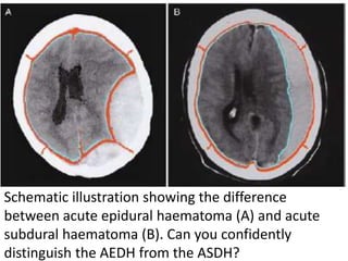 Schematic illustration showing the difference
between acute epidural haematoma (A) and acute
subdural haematoma (B). Can you confidently
distinguish the AEDH from the ASDH?
 