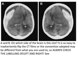 A and B. On which side of the brain is this clot? It is so easy to
inadvertently flip the CT films or the convention adopted may
be different from what you are used to; so ALWAYS CHECK
THE LABELLING OFLEFT AND RIGHT! See
 