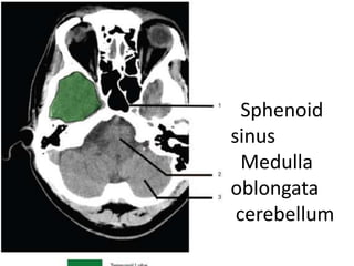 Sphenoid
sinus
Medulla
oblongata
cerebellum
 