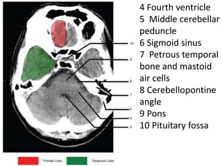 4 Fourth ventricle
5 Middle cerebellar
peduncle
6 Sigmoid sinus
7 Petrous temporal
bone and mastoid
air cells
8 Cerebellopontine
angle
9 Pons
10 Pituitary fossa
 