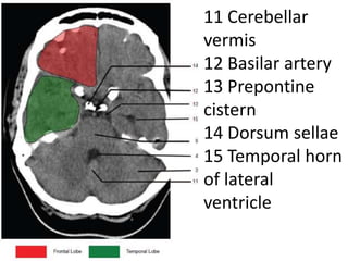 11 Cerebellar
vermis
12 Basilar artery
13 Prepontine
cistern
14 Dorsum sellae
15 Temporal horn
of lateral
ventricle
 