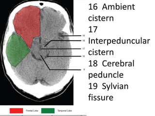 16 Ambient
cistern
17
Interpeduncular
cistern
18 Cerebral
peduncle
19 Sylvian
fissure
 
