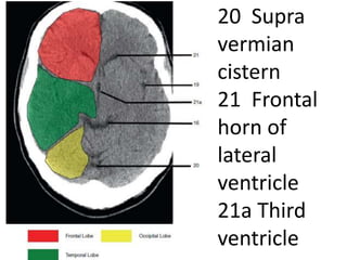 20 Supra
vermian
cistern
21 Frontal
horn of
lateral
ventricle
21a Third
ventricle
 