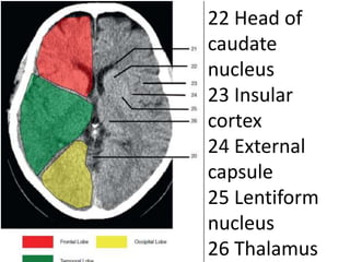 22 Head of
caudate
nucleus
23 Insular
cortex
24 External
capsule
25 Lentiform
nucleus
26 Thalamus
 