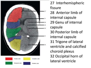 27 Interhemispheric
fissure
28 Anterior limb of
internal capsule
29 Genu of internal
capsule
30 Posterior limb of
internal capsule
31 Trigone of lateral
ventricle and calcified
choroid plexus
32 Occipital horn of
lateral ventricle
 
