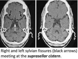 Right and left sylvian fissures (black arrows)
meeting at the suprasellar cistern.
 