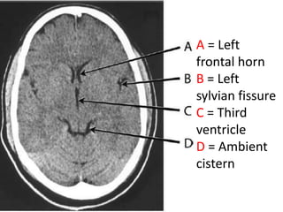 A = Left
frontal horn
B = Left
sylvian fissure
C = Third
ventricle
D = Ambient
cistern
 