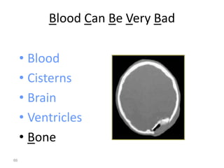 Blood Can Be Very Bad
• Blood
• Cisterns
• Brain
• Ventricles
• Bone
66
 