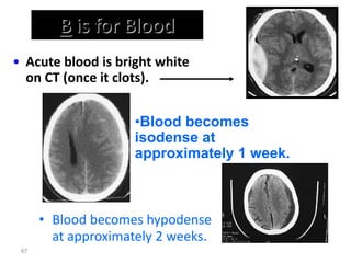 B is for Blood
• Blood becomes hypodense
at approximately 2 weeks.
67
•Blood becomes
isodense at
approximately 1 week.
• Acute blood is bright white
on CT (once it clots).
 