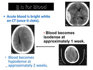 B is for Blood
• Blood becomes
hypodense at
approximately 2 weeks.
68
• Blood becomes
isodense at
approximately 1 week.
• Acute blood is bright white
on CT (once it clots).
 