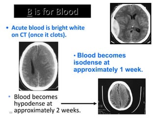 B is for Blood
• Blood becomes
hypodense at
approximately 2 weeks.
69
• Blood becomes
isodense at
approximately 1 week.
• Acute blood is bright white
on CT (once it clots).
 