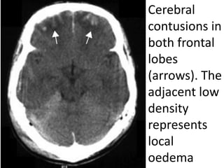 Cerebral
contusions in
both frontal
lobes
(arrows). The
adjacent low
density
represents
local
oedema
 