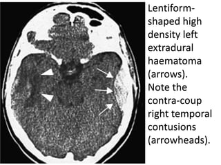 Lentiform-
shaped high
density left
extradural
haematoma
(arrows).
Note the
contra-coup
right temporal
contusions
(arrowheads).
 