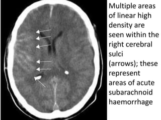 Multiple areas
of linear high
density are
seen within the
right cerebral
sulci
(arrows); these
represent
areas of acute
subarachnoid
haemorrhage
 