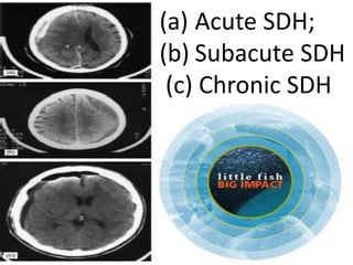 (a) Acute SDH;
(b) Subacute SDH
(c) Chronic SDH
 