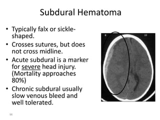 Subdural Hematoma
• Typically falx or sickle-
shaped.
• Crosses sutures, but does
not cross midline.
• Acute subdural is a marker
for severe head injury.
(Mortality approaches
80%)
• Chronic subdural usually
slow venous bleed and
well tolerated.
96
 