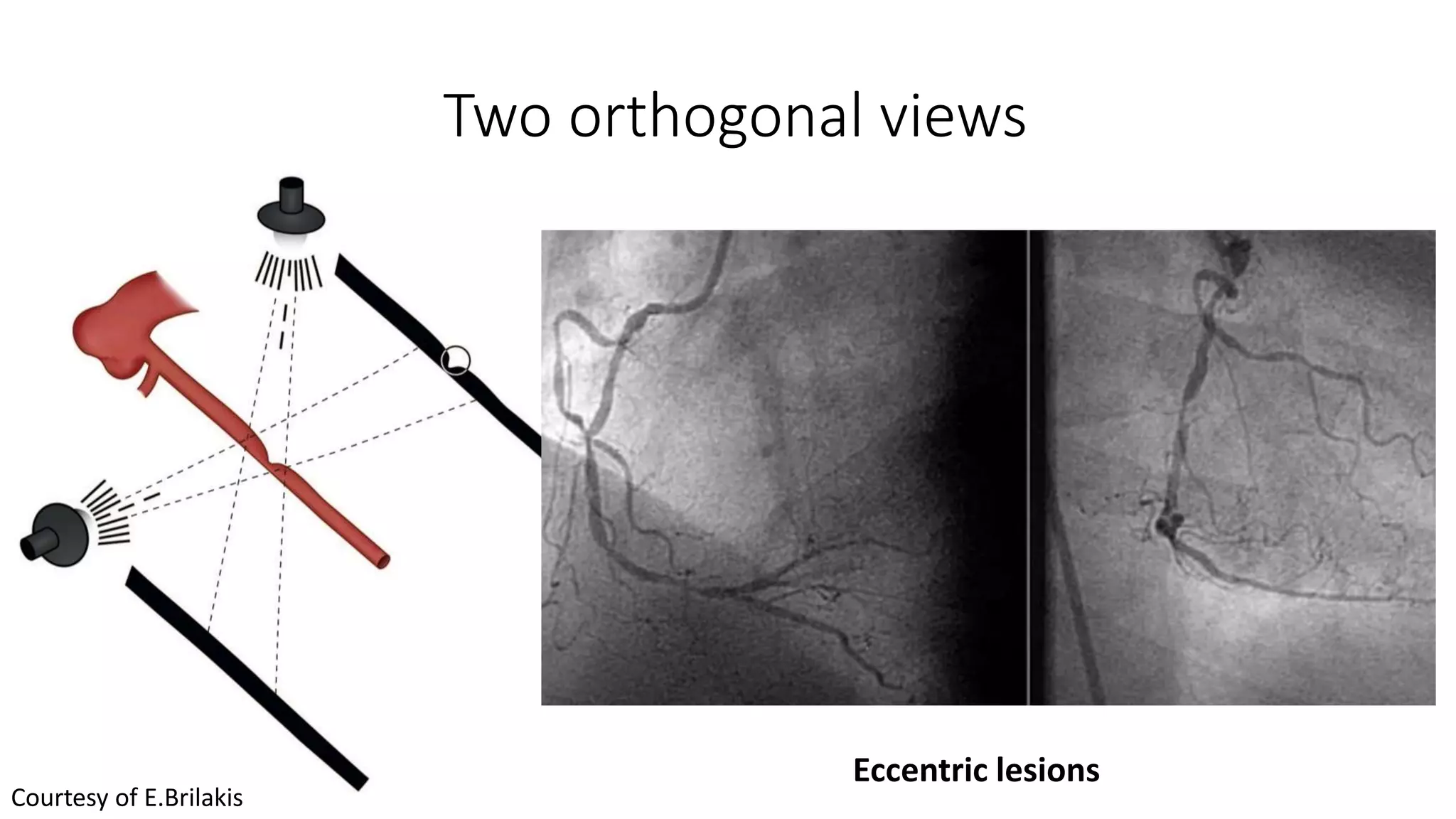 How to read coronary angiography | PPTX