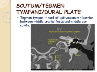Scutum In Ear How to read ct scan temporal bone - A dhulikhel hospital, kathmandu ...