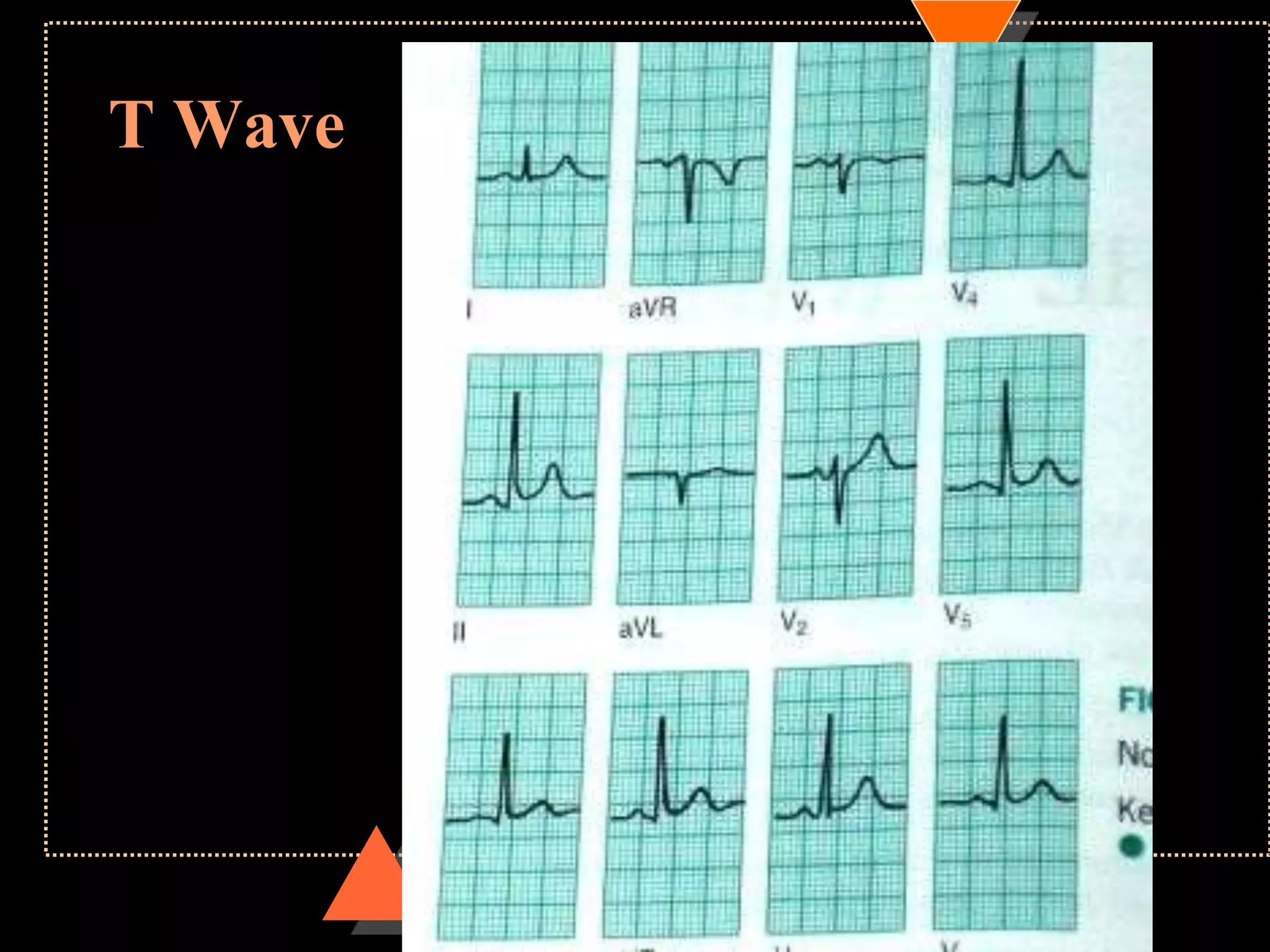 T Wave
 