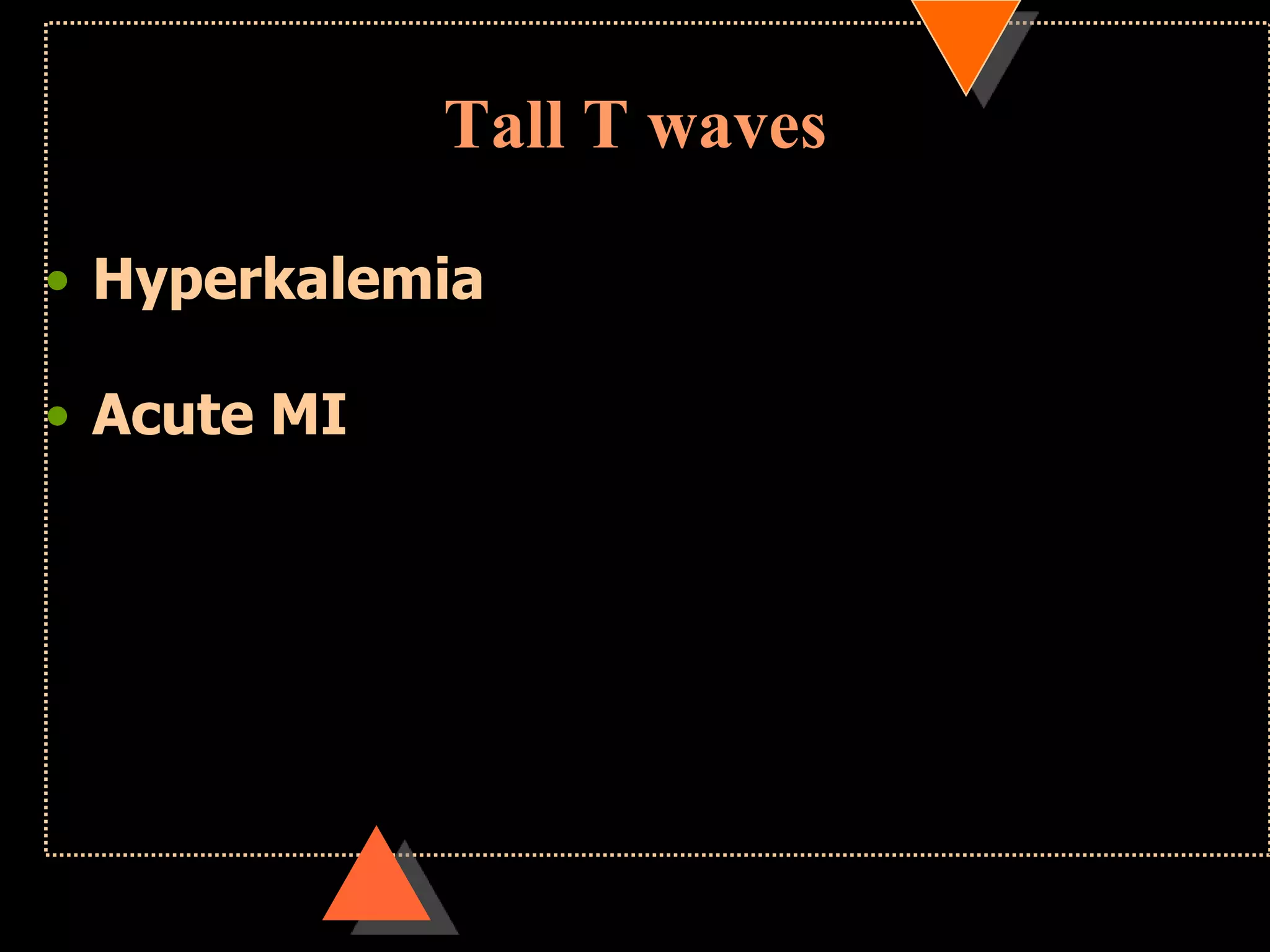 Tall T waves
• Hyperkalemia
• Acute MI
 