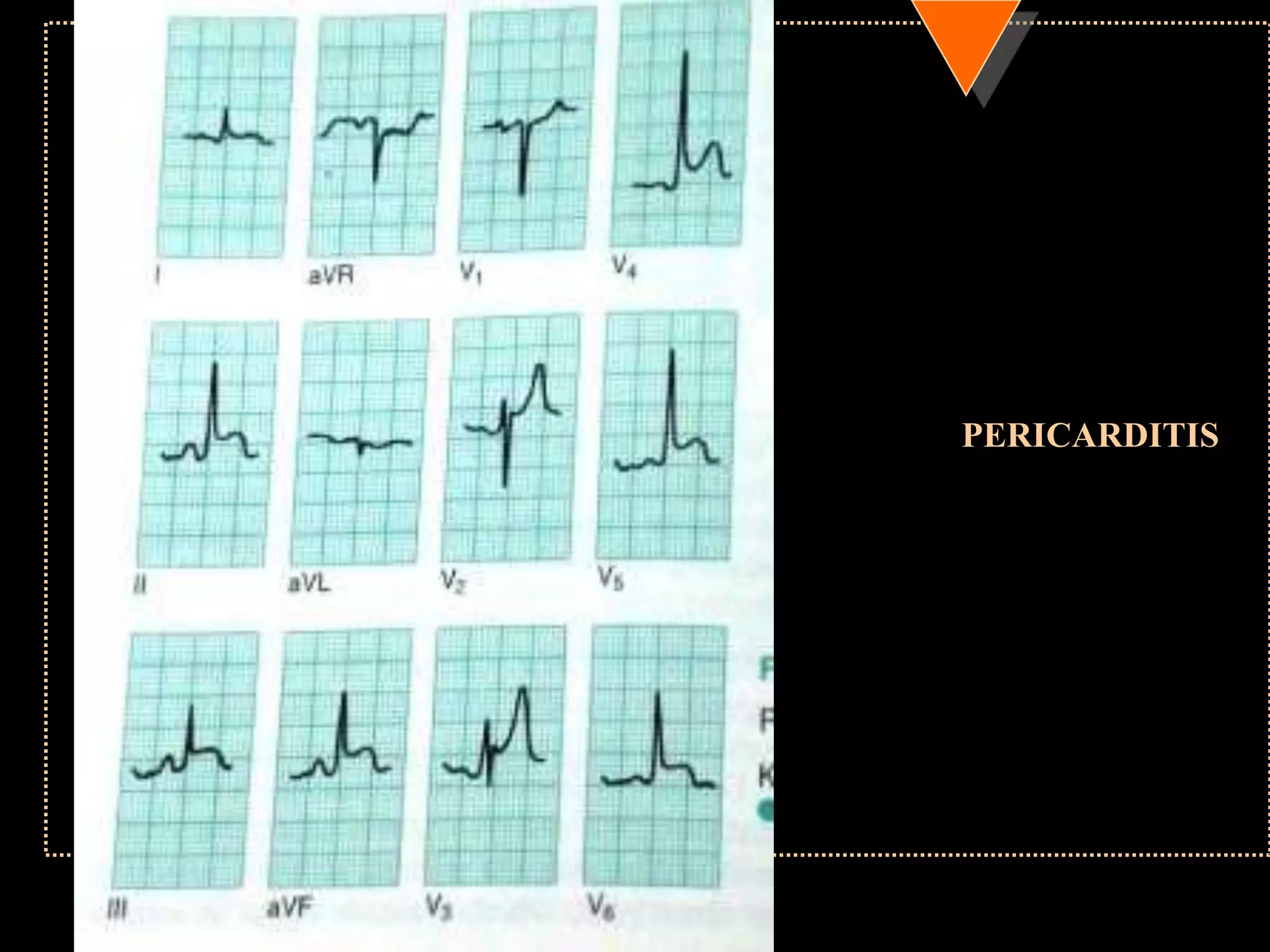 PERICARDITIS
 