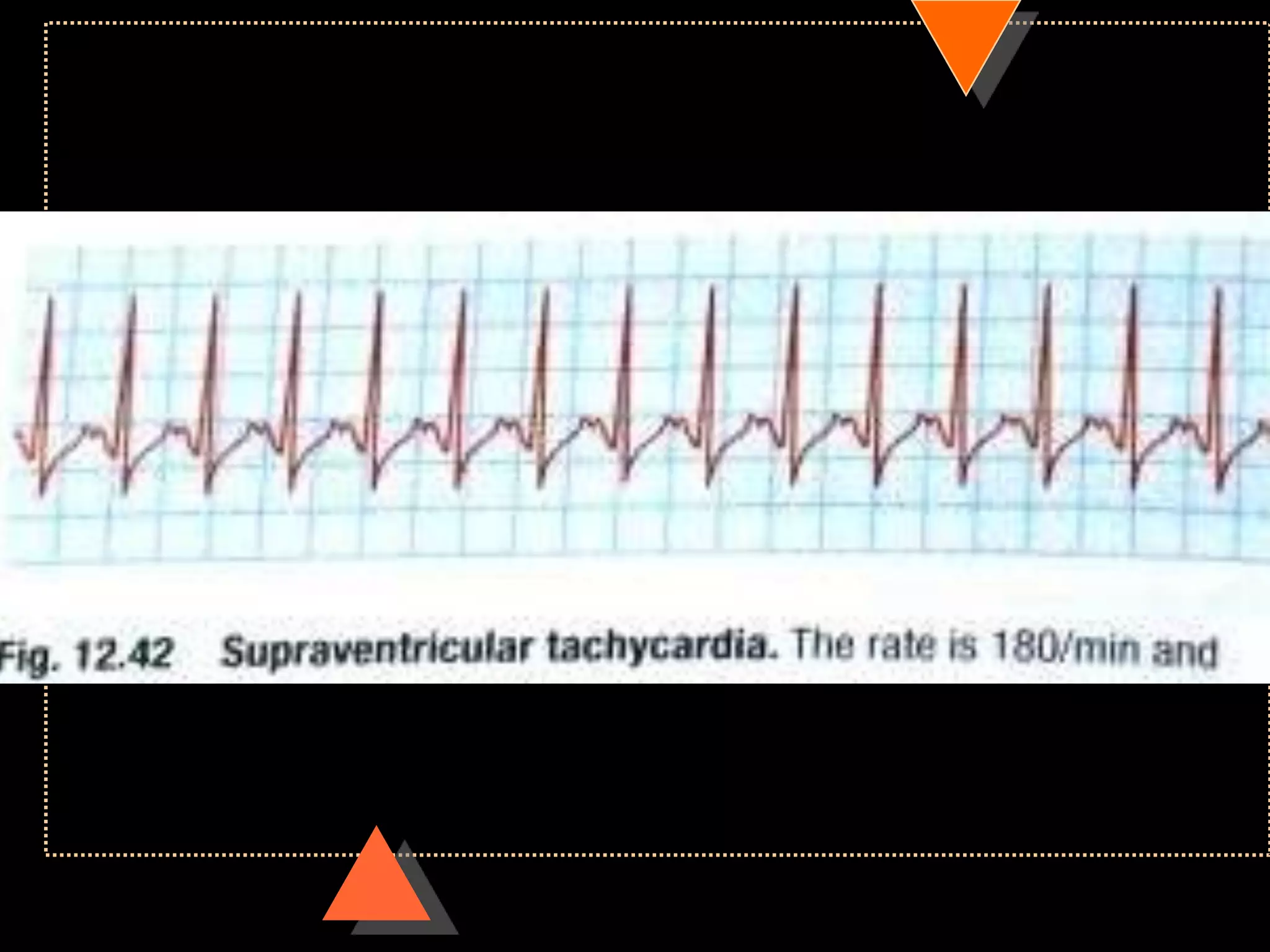 How to read ECG