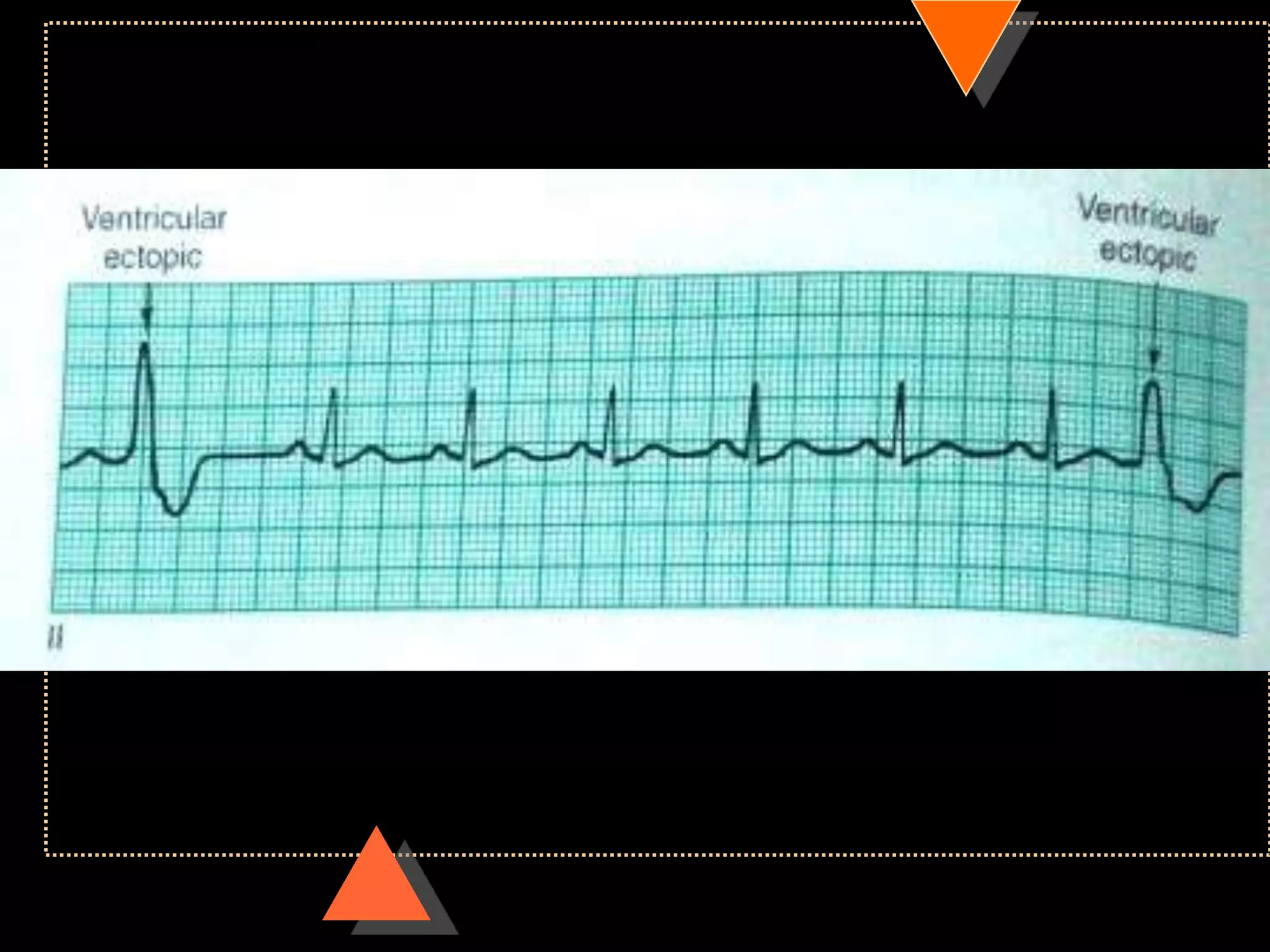 How to read ECG