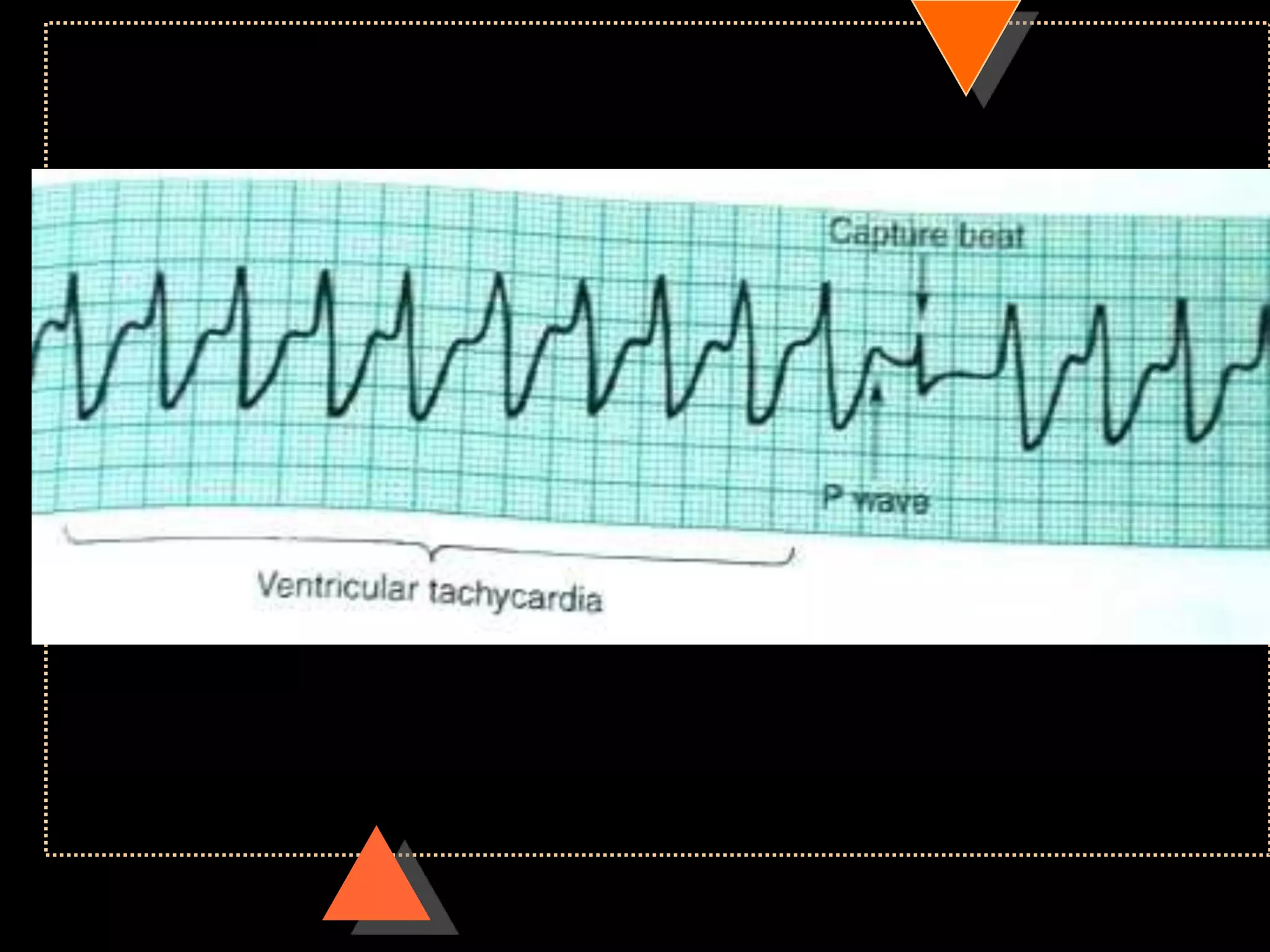 How to read ECG
