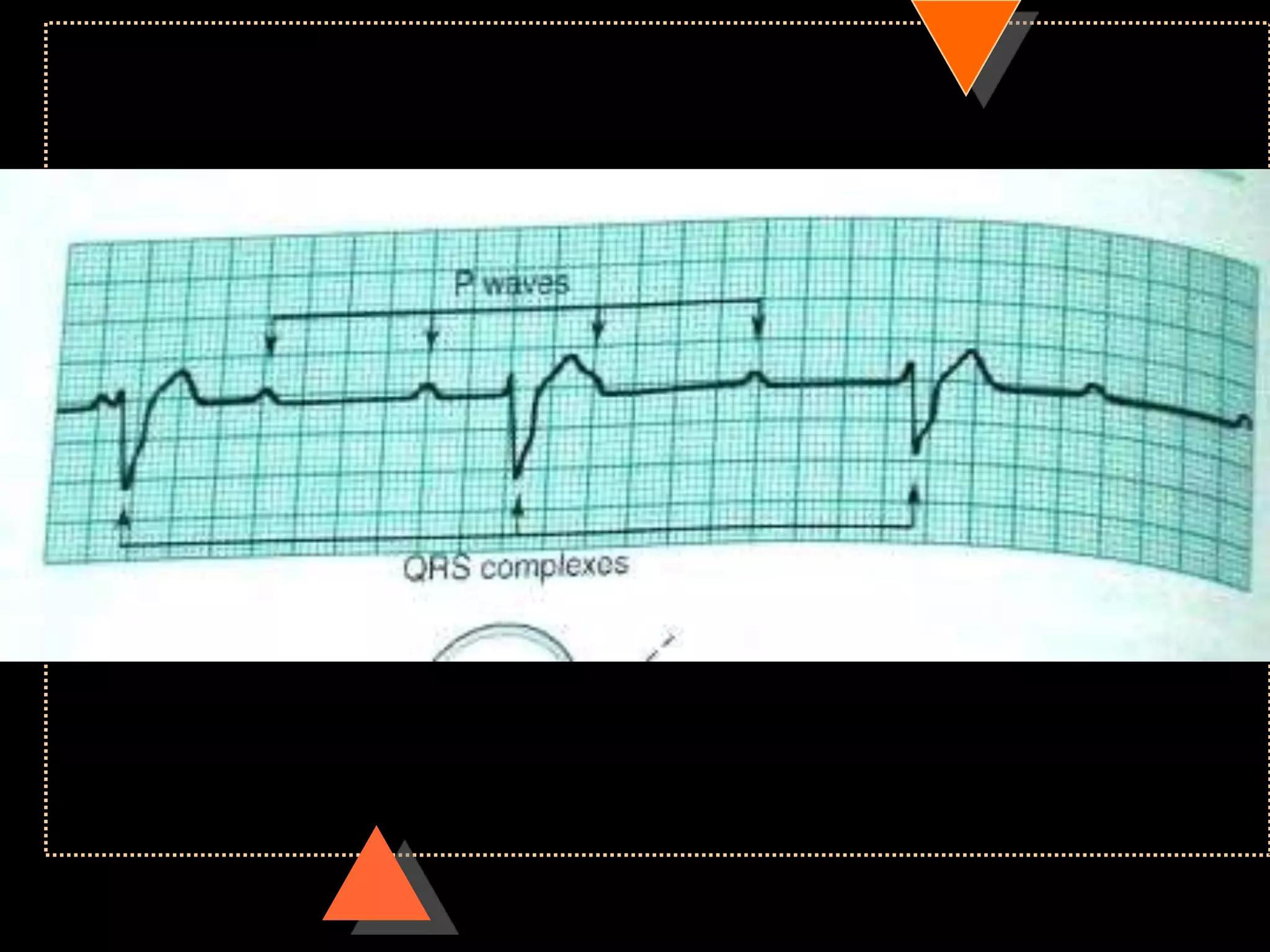 How to read ECG
