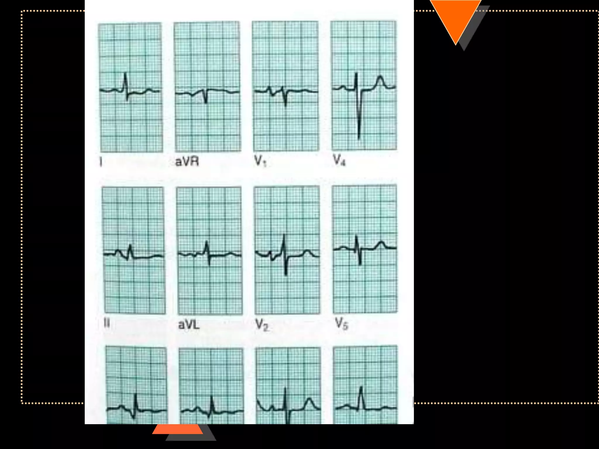 How to read ECG