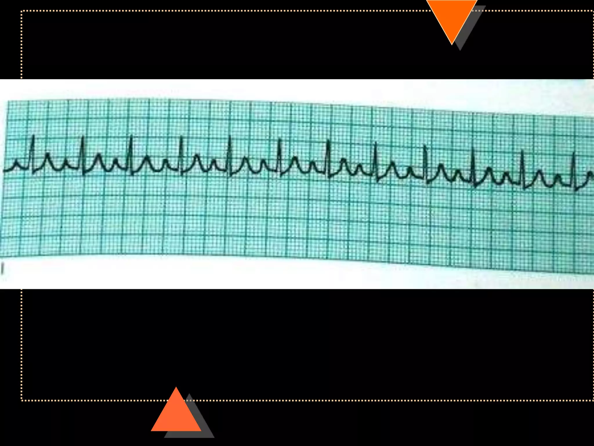 How to read ECG