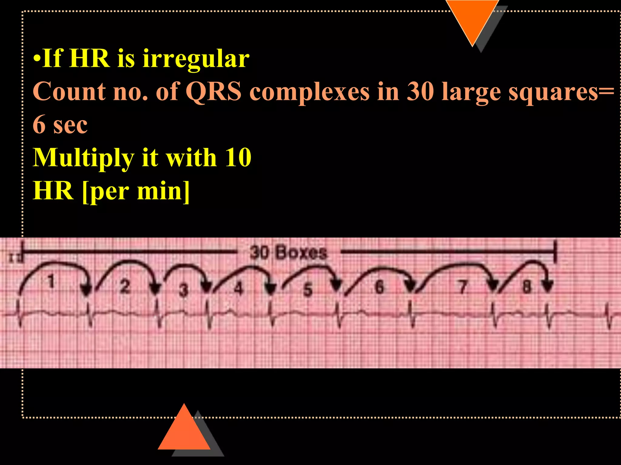 •If HR is irregular
Count no. of QRS complexes in 30 large squares=
6 sec
Multiply it with 10
HR [per min]
 