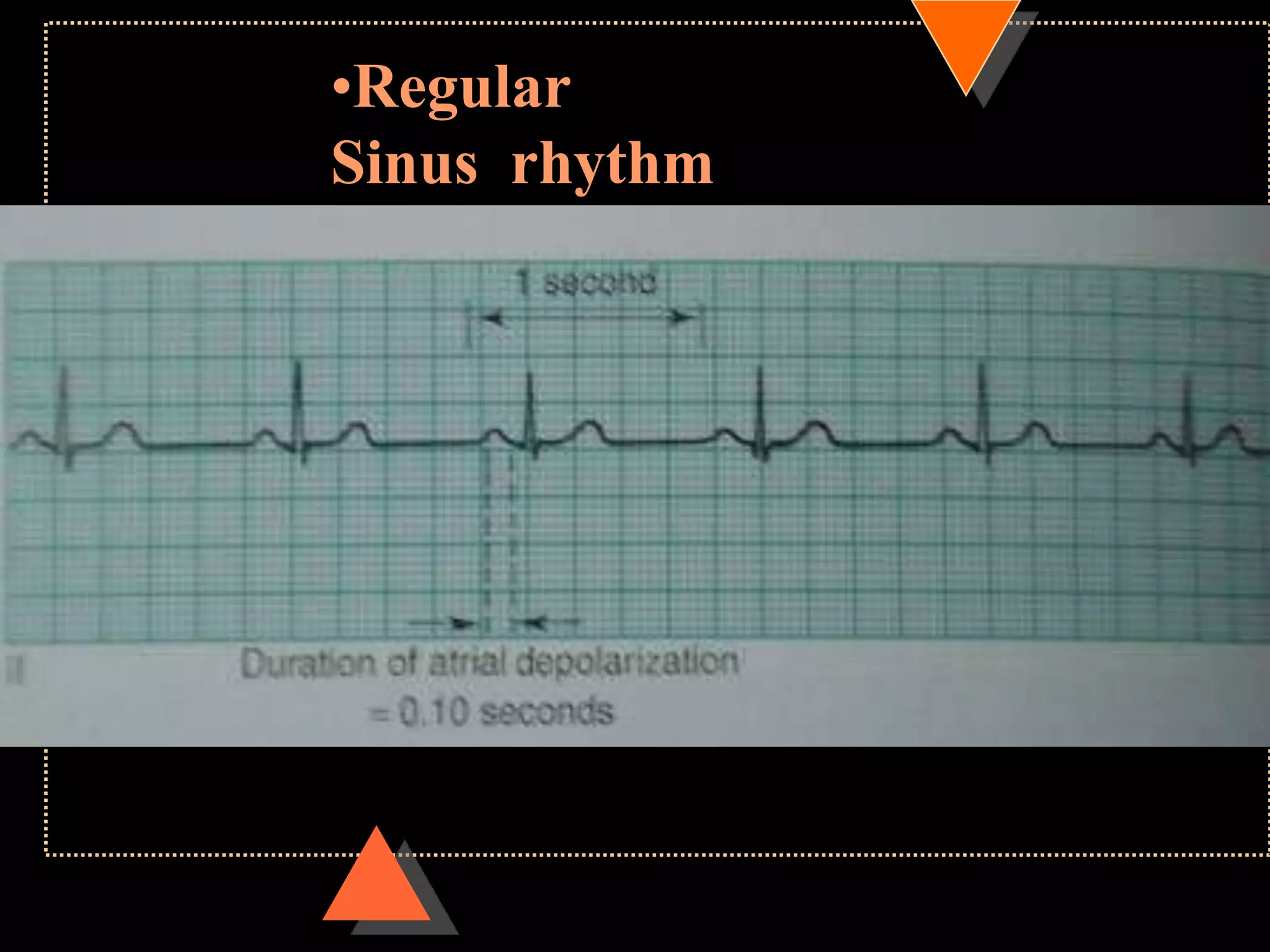 •Regular
Sinus rhythm
 