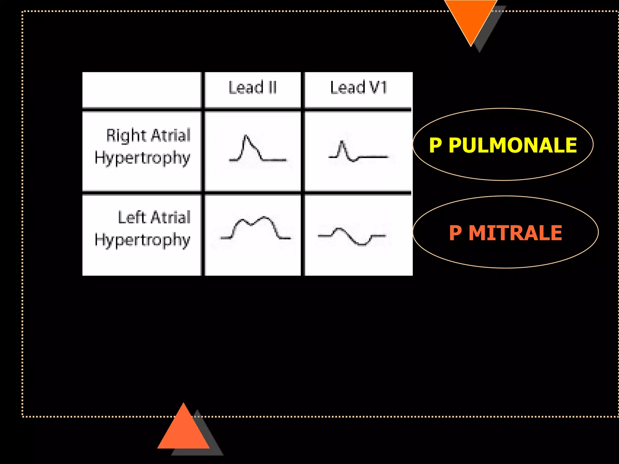 P PULMONALE
P MITRALE
 