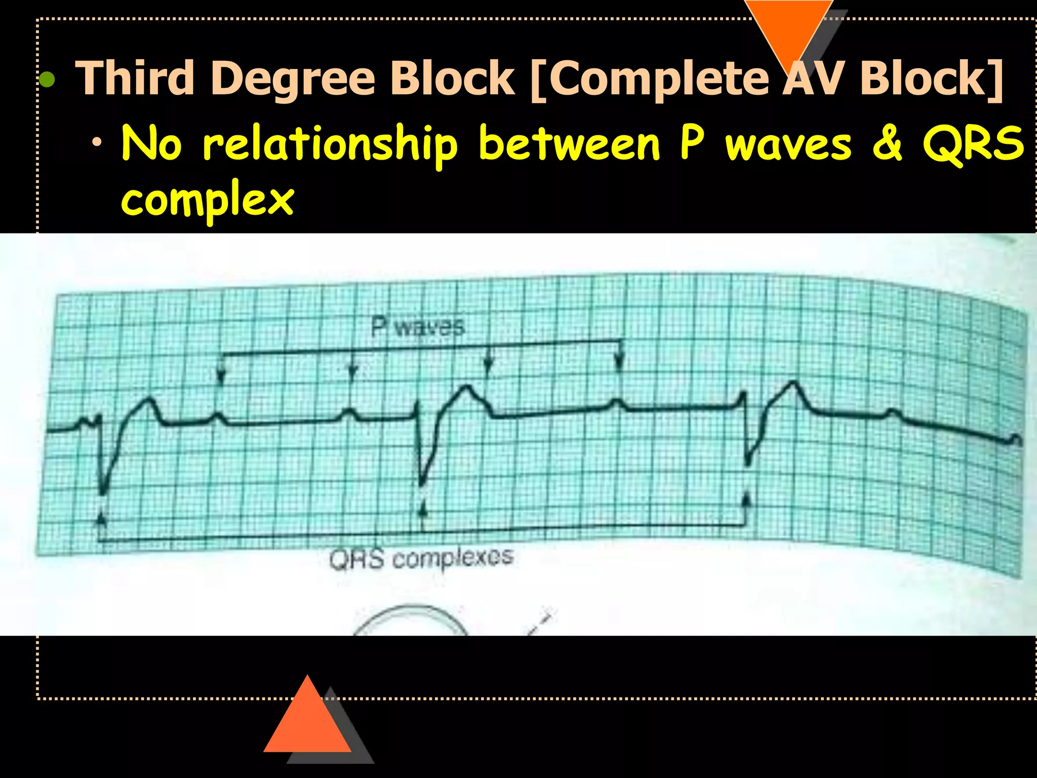 • Third Degree Block [Complete AV Block]
• No relationship between P waves & QRS
complex
 