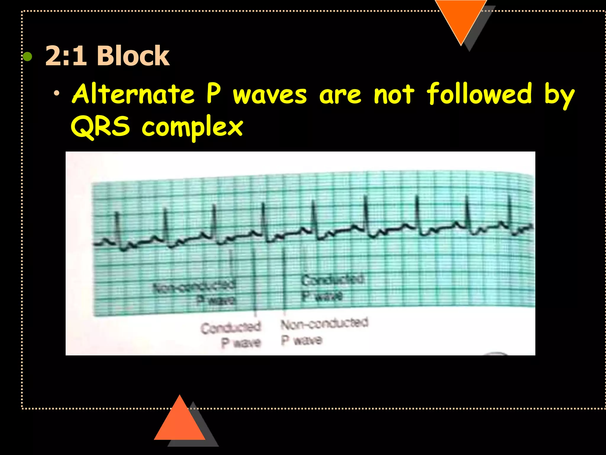 • 2:1 Block
• Alternate P waves are not followed by
QRS complex
 