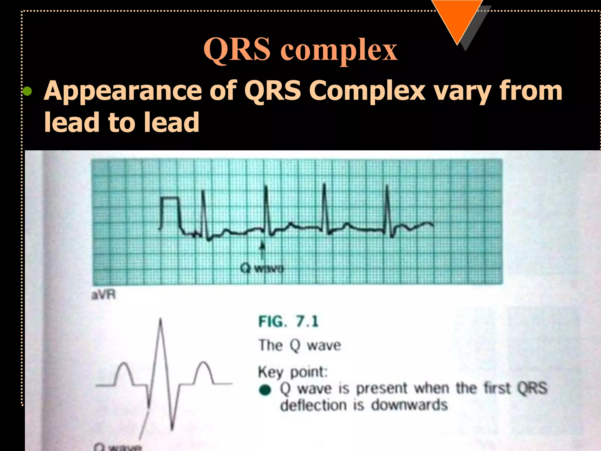 QRS complex
• Appearance of QRS Complex vary from
lead to lead
 