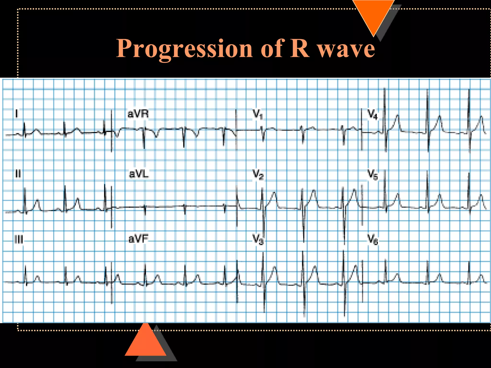 Progression of R wave
 
