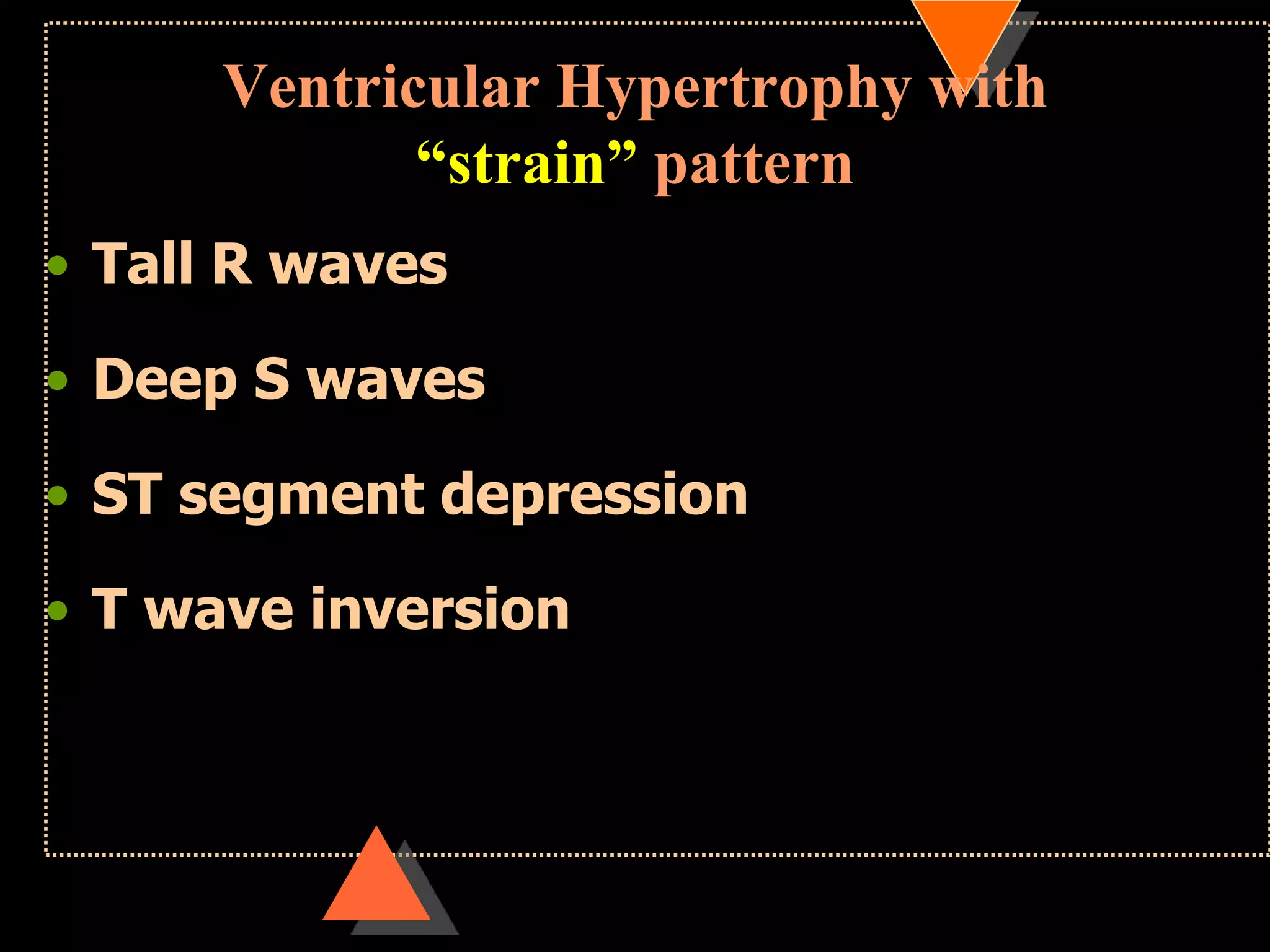 Ventricular Hypertrophy with
“strain” pattern
• Tall R waves
• Deep S waves
• ST segment depression
• T wave inversion
 