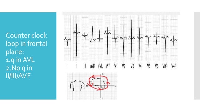 How to read 12 lead ECG