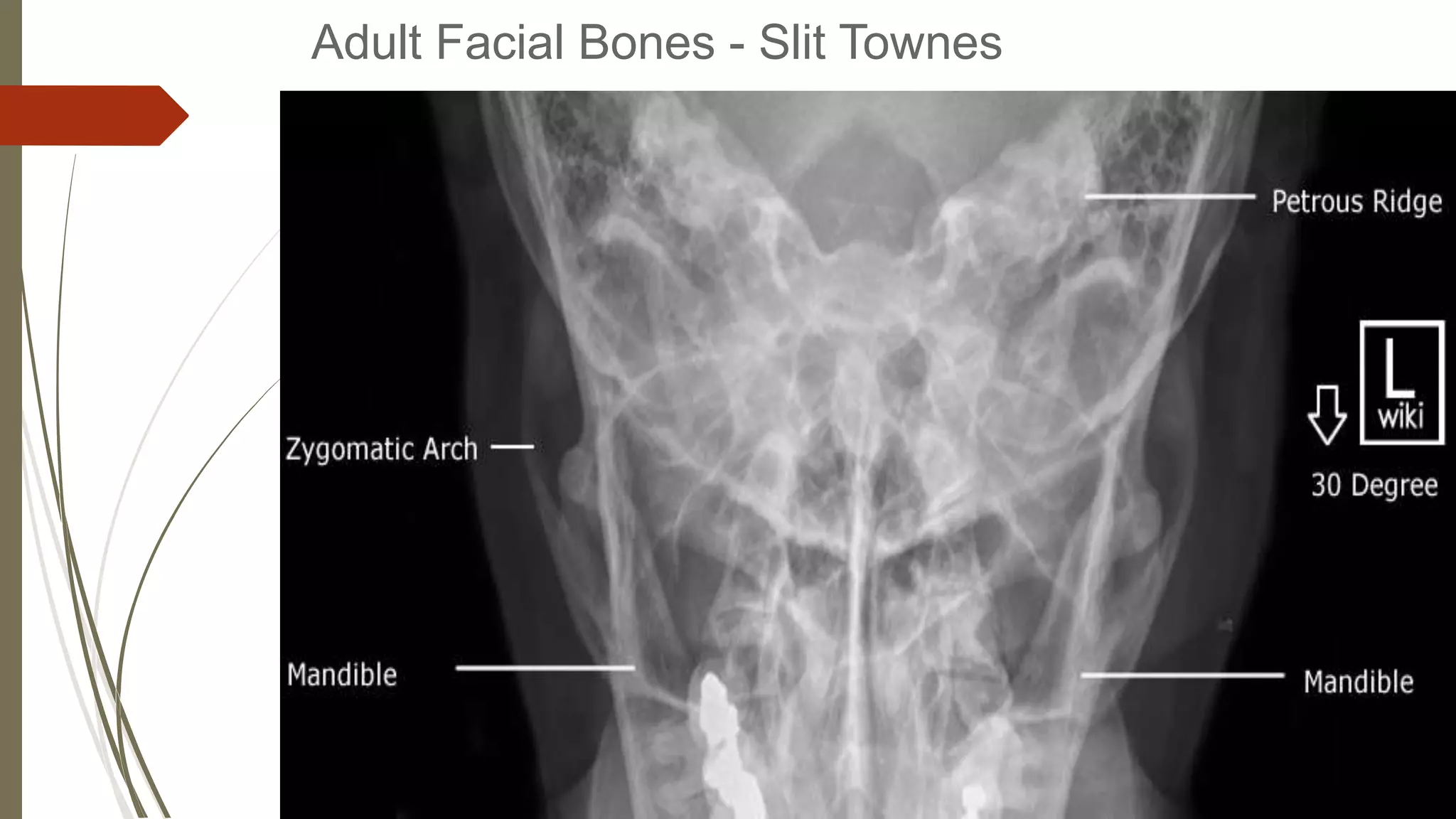 How To Read Facial Bone X-Rays By Peter Andre Soltau -Jan2015 | PPTX