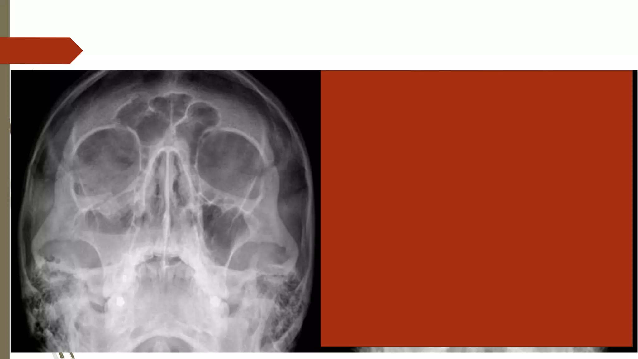 How To Read Facial Bone X-Rays By Peter Andre Soltau -Jan2015 | PPTX
